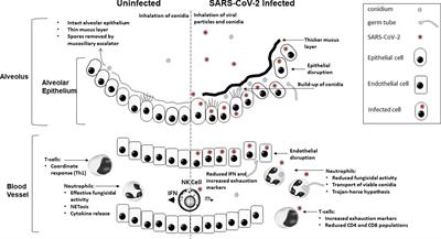 Defective antifungal immunity in patients with COVID-19